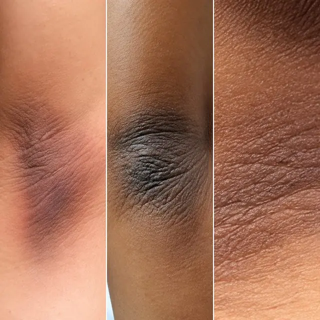 Áreas do corpo mais escurecidas que o resto da pele